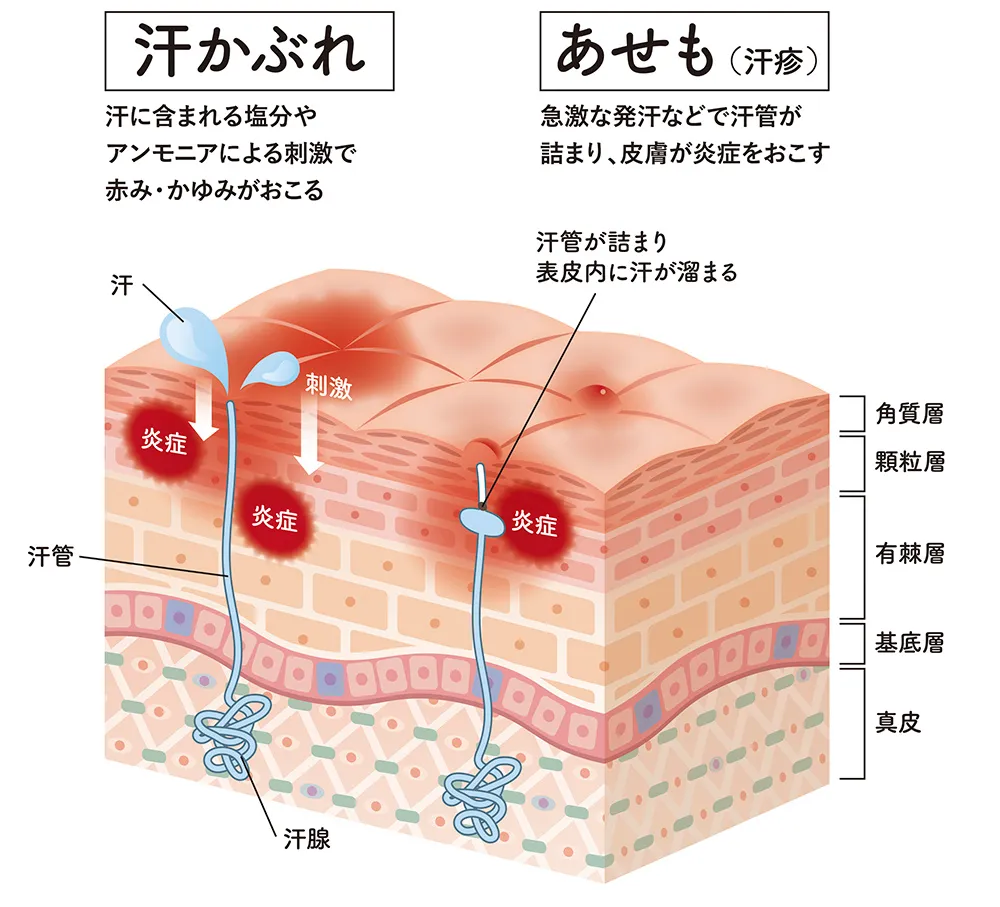 あせも マンション